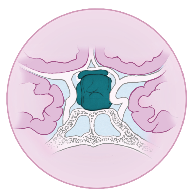 Image - Indications Acromegaly